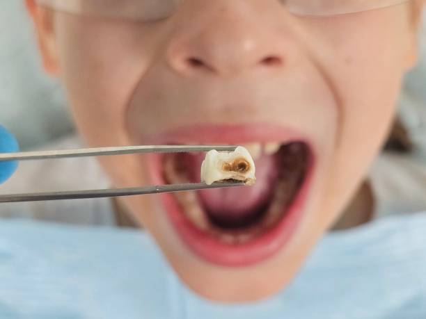 Best Emergency Root Canal Treatment in St Joseph, MI